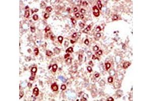 IHC testing of human hepatocarcinoma stained with SUMO2/3 antibody. (SUMO2/3 antibody  (AA 49-81))