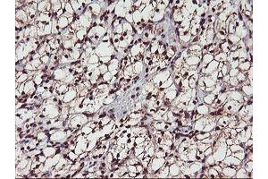 Immunohistochemical staining of paraffin-embedded Carcinoma of Human kidney tissue using anti-MGLL mouse monoclonal antibody.