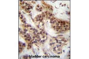 FOXA2 Antibody (Center ) (ABIN657130 and ABIN2846274) immunohistochemistry analysis in formalin fixed and paraffin embedded human bladder carcinoma followed by peroxidase conjugation of the secondary antibody and DAB staining. (FOXA2 antibody  (AA 134-163))