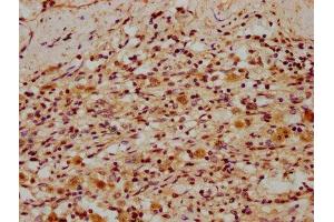 IHC image of ABIN7150293 diluted at 1:300 and staining in paraffin-embedded human lung cancer performed on a Leica BondTM system. (REV1 antibody  (AA 1035-1160))