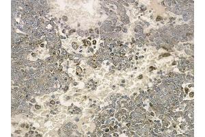 ABIN6259198 and ABIN6274317 at 1/100 staining human melanoma by IHC-P. (SSBP1 antibody  (Internal Region))