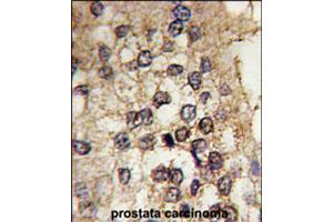 Formalin-fixed and paraffin-embedded human prostate carcinoma tissue reacted with CLOCK polyclonal antibody  , which was peroxidase-conjugated to the secondary antibody, followed by DAB staining. (CLOCK antibody  (Internal Region))