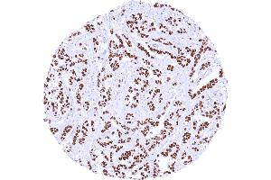 Invasive breast cancer of no special type NST with intense nuclear TRPS1 positivity Dilution 1:600 (Recombinant TRPS1 antibody  (AA 900-1100))