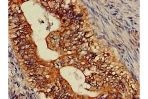 Immunohistochemistry of paraffin-embedded human colon cancer using ABIN7144771 at dilution of 1:100 (Astrotactin 2 antibody  (AA 108-272))