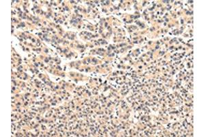 The image on the left is immunohistochemistry of paraffin-embedded Human liver cancer tissue using ABIN7131583(VPS37A Antibody) at dilution 1/20, on the right is treated with fusion protein. (VPS37A antibody)