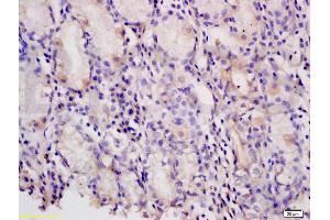 Formalin-fixed and paraffin embedded human gastric carcinoma tissue labeled with Anti-PAF Polyclonal Antibody, Unconjugated (ABIN737931) at 1:200 followed by conjugation to the secondary antibody and DAB staining (KIAA0101 antibody)