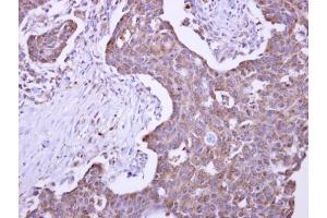 IHC-P Image Malectin antibody detects KIAA0152 protein at cytosol on human colon carcinoma by immunohistochemical analysis. (Malectin antibody)