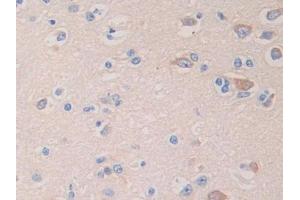 Used in DAB staining on fromalin fixed paraffin- embedded stomach cancer tissue (GLDC antibody  (AA 81-268))