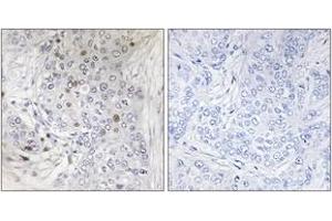 Immunohistochemistry analysis of paraffin-embedded human breast carcinoma tissue, using MAFF Antibody. (MafF antibody  (AA 51-100))
