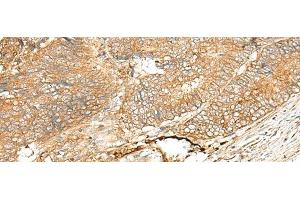 Immunohistochemistry of paraffin-embedded Human colorectal cancer tissue using ADGRF5 Polyclonal Antibody at dilution of 1:40(x200) (G Protein-Coupled Receptor 116 antibody)