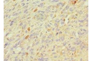 Immunohistochemistry of paraffin-embedded human melanoma using ABIN7154393 at dilution of 1:100 (Granulin antibody  (AA 20-310))