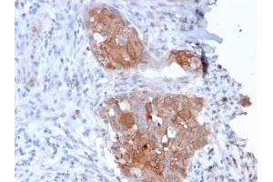 Formalin-fixed, paraffin-embedded human Bladder Carcinoma stained with Desmoglein-1 Mouse Monoclonal Antibody (32-2B). (Desmoglein 1 antibody)