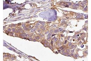 ABIN6272998 at 1/100 staining Human breast cancer tissue by IHC-P. (ENOX2 antibody  (N-Term))
