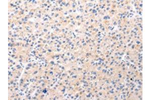The image on the left is immunohistochemistry of paraffin-embedded Human liver cancer tissue using ABIN7190022(BSN Antibody) at dilution 1/20, on the right is treated with synthetic peptide. (Bassoon antibody)