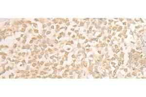 Immunohistochemistry of paraffin-embedded Human ovarian cancer tissue using DUSP27 Polyclonal Antibody at dilution of 1:50(x200) (DUSP27/STYXL2 antibody)