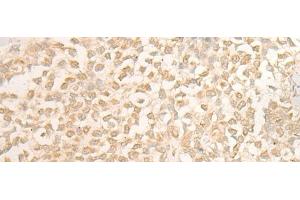 Immunohistochemistry of paraffin-embedded Human ovarian cancer tissue using DUSP27 Polyclonal Antibody at dilution of 1:50(x200)