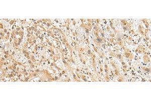 Immunohistochemistry of paraffin-embedded Human liver cancer tissue using NUDT12 Polyclonal Antibody at dilution of 1:25(x200) (NUDT12 antibody)