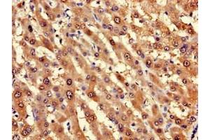Immunohistochemistry of paraffin-embedded human liver cancer using ABIN7143224 at dilution of 1:100 (LPGAT1 antibody  (AA 151-341))