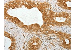 The image on the left is immunohistochemistry of paraffin-embedded Human cervical cancer tissue using ABIN7131317(TEKT1 Antibody) at dilution 1/30, on the right is treated with fusion protein.