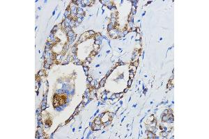 Immunohistochemistry of paraffin-embedded Human thyroid cancer using CYP51 Rabbit pAb (3485) at dilution of 1:50 (40x lens). (CYP51A1 antibody  (AA 210-509))
