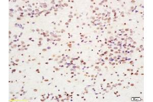 Formalin-fixed and paraffin embedded human glima labeled with Anti-Cdc7 Polyclonal Antibody, Unconjugated (ABIN755557) at 1:200 followed by conjugation to the secondary antibody and DAB staining. (CDC7 antibody  (AA 151-250))