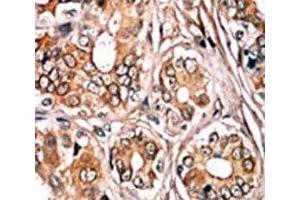 IHC analysis of FFPE human breast carcinoma tissue stained with the phospho-Rb antibody.