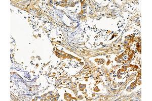 ABIN7095732 and ABIN7099794 at 1/100 staining human pancreatic cancer by IHC-P.