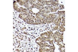 Immunohistochemistry of paraffin-embedded human colon carcinoma using [KO Validated] ST Rabbit mAb (ABIN7270305) at dilution of 1:100 (40x lens). (STAT3 antibody)