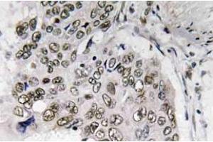 Immunohistochemistry (IHC) analyzes of Smad6 antibody in paraffin-embedded human lung carcinoma tissue. (SMAD6 antibody)