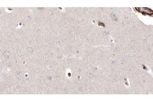 ABIN6272927 at 1/100 staining Human brain cancer tissue by IHC-P. (PIEZO1 antibody  (Internal Region))