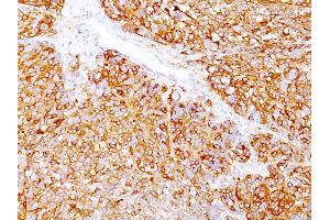 Formalin-fixed, paraffin-embedded human Melanoma stained with Melanoma Marker Mouse Monoclonal Antibody (DT101+ BC199 + HMB45). (MLANA & SILV antibody)