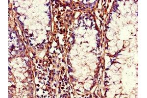 Immunohistochemistry of paraffin-embedded human colon cancer using ABIN7155925 at dilution of 1:100 (CDC37 antibody  (AA 89-175))
