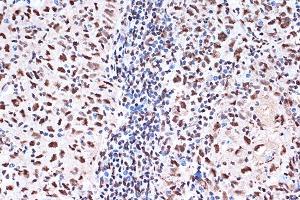 Immunohistochemistry of paraffin-embedded human esophageal cancer using KHSRP Rabbit mAb (ABIN7268110) at dilution of 1:100 (40x lens). (KHSRP antibody)