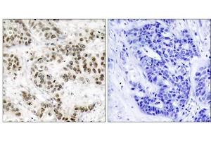 Immunohistochemical analysis of paraffin-embedded human breast carcinoma tissue using SAPK/JNK (Ab-185) antibody (E021242). (SAPK, JNK antibody)
