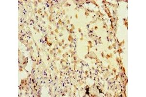 Immunohistochemistry of paraffin-embedded human lung cancer using ABIN7155425 at dilution of 1: 100 (Histone 3 antibody  (AA 2-30))