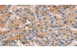 Immunohistochemistry of paraffin-embedded Human liver cancer tissue using ALOX15 Polyclonal Antibody at dilution 1:50 (ALOX15 antibody)