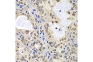 Immunohistochemistry of paraffin-embedded human oophoroma using MCM3 antibody at dilution of 1:100 (400x lens).