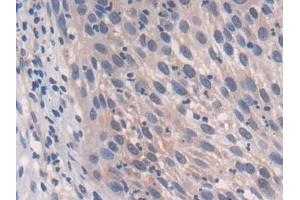 Detection of CPR in Human Lung cancer Tissue using Polyclonal Antibody to Cytochrome P450 Reductase (CPR)