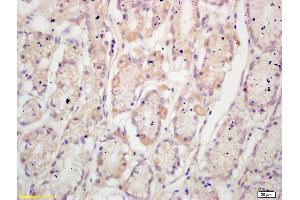 Formalin-fixed and paraffin embedded human gastric cancer labeled with Anti-TFF2 Polyclonal Antibody, Unconjugated (ABIN736403) at 1:200 followed by conjugation to the secondary antibody and DAB staining (Trefoil Factor 2 antibody  (AA 51-129))