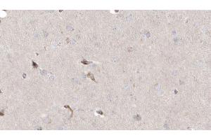 ABIN6272925 at 1/100 staining Human brain cancer tissue by IHC-P. (MLYCD antibody  (Internal Region))