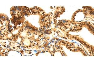 Immunohistochemistry of paraffin-embedded Human thyroid cancer tissue using SERPINB1 Polyclonal Antibody at dilution 1:30 (SERPINB1 antibody)