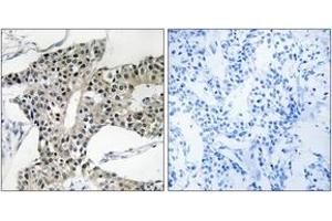 Immunohistochemistry analysis of paraffin-embedded human breast carcinoma tissue, using ARSK Antibody.