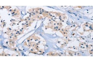 Immunohistochemistry of paraffin-embedded Human thyroid cancer using CARD14 Polyclonal Antibody at dilution of 1:30 (CARD14 antibody)