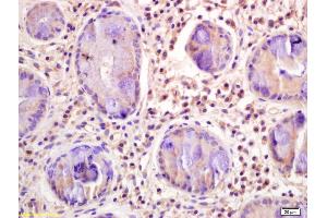 Formalin-fixed and paraffin embedded human gastric carcinoma labeled with Rabbit Anti CD33/Siglec-3 Polyclonal Antibody, Unconjugated (ABIN676958) at 1:200 followed by conjugation to the secondary antibody and DAB staining (CD33 antibody  (AA 261-364))