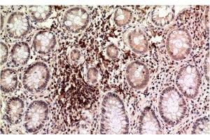 Immunohistochemistry of paraffin-embedded Human colon carcinoma tissue using Epsilon Tubulin Monoclonal Antibody at dilution of 1:200. (TUBE1 antibody)