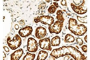 ABIN6260614 and ABIN6277051 at 1/100 staining Human kidney cancer and adjacent normal tissues by IHC-P. (CD33 antibody  (C-Term))