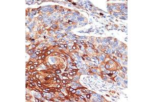 Immunohistochemistry of paraffin-embedded human esophageal cancer using ORM1/2 Rabbit mAb (ABIN7269114) at dilution of 1:100 (40x lens). (Orosomucoid 2 antibody)