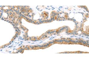 Immunohistochemistry of paraffin-embedded Human thyroid cancer using TNIP2 Polyclonal Antibody at dilution of 1:35 (TNIP2 antibody)