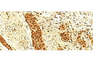 Immunohistochemistry of paraffin-embedded Human esophagus cancer tissue using UNKL Polyclonal Antibody at dilution of 1:50(x200) (UNKL antibody)