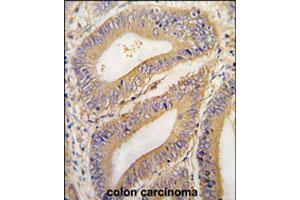 Formalin-fixed and paraffin-embedded human colon carcinoma tissue reacted with PHB2 polyclonal antibody  , which was peroxidase-conjugated to the secondary antibody, followed by DAB staining. (Prohibitin 2 antibody  (N-Term))
